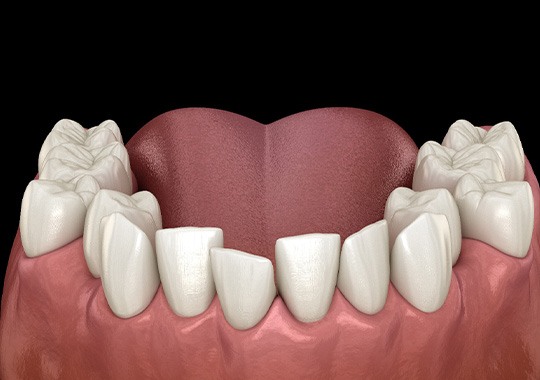 Illustration of crooked teeth