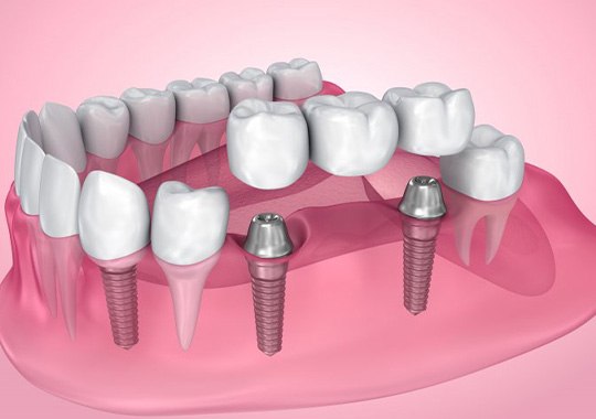 Exploded illustration of dental implants with bridge