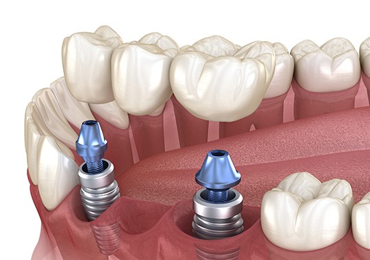 Illustration of implant bridge