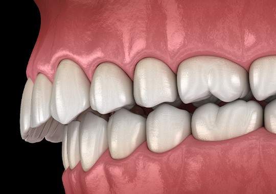Illustration of an overbite