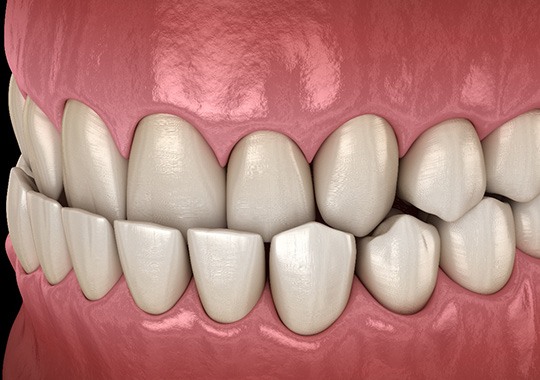 Illustration of an underbite