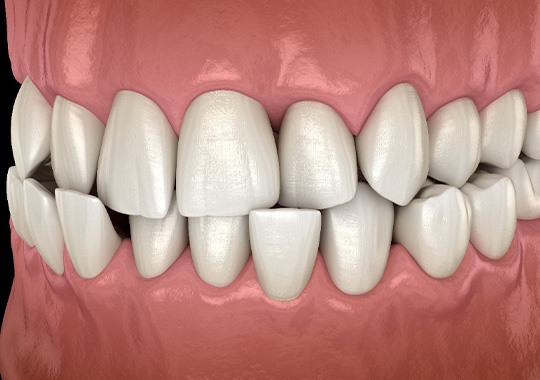 Illustration of a crossbite