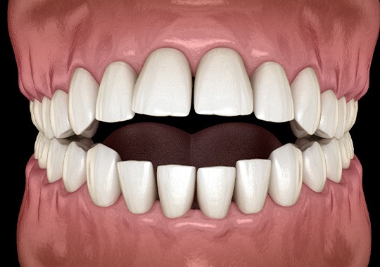 Illustration of an open bite