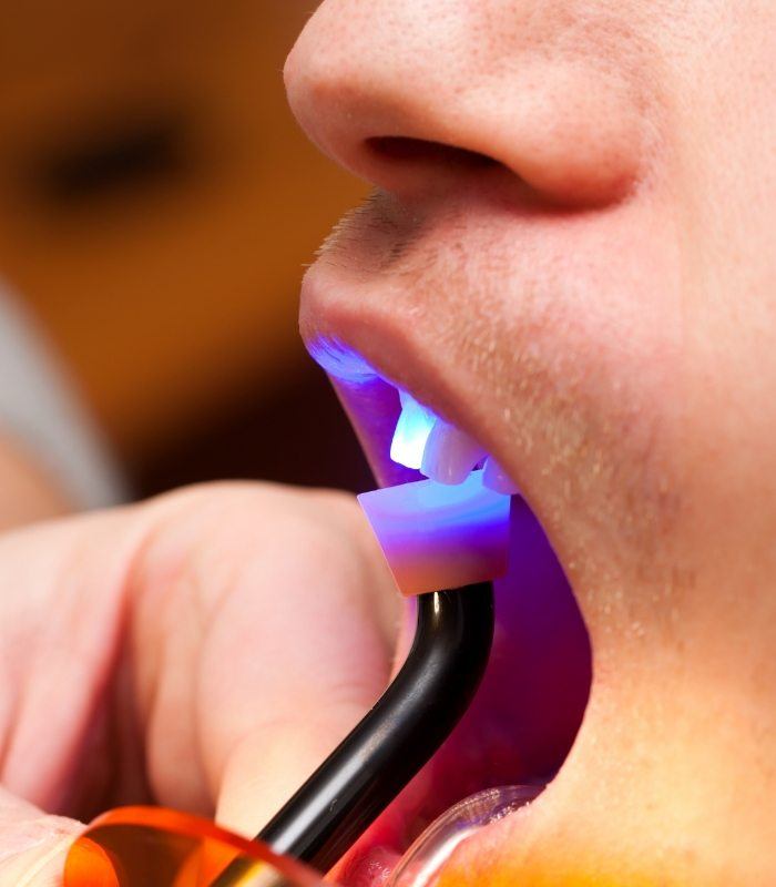 Close up of dental patient getting direct bonding on a front tooth