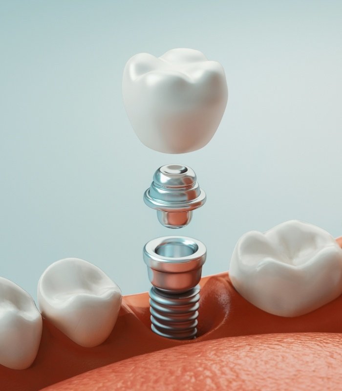 Illustrated dental implant in Owasso replacing a missing tooth