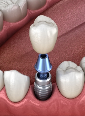 Illustrated dental crown being placed onto a dental implant