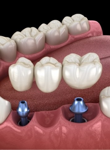 Illustrated dental bridge being placed onto two dental implants