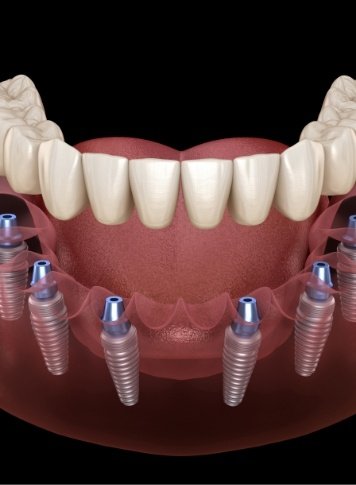 Illustrated full denture being placed onto six dental implants