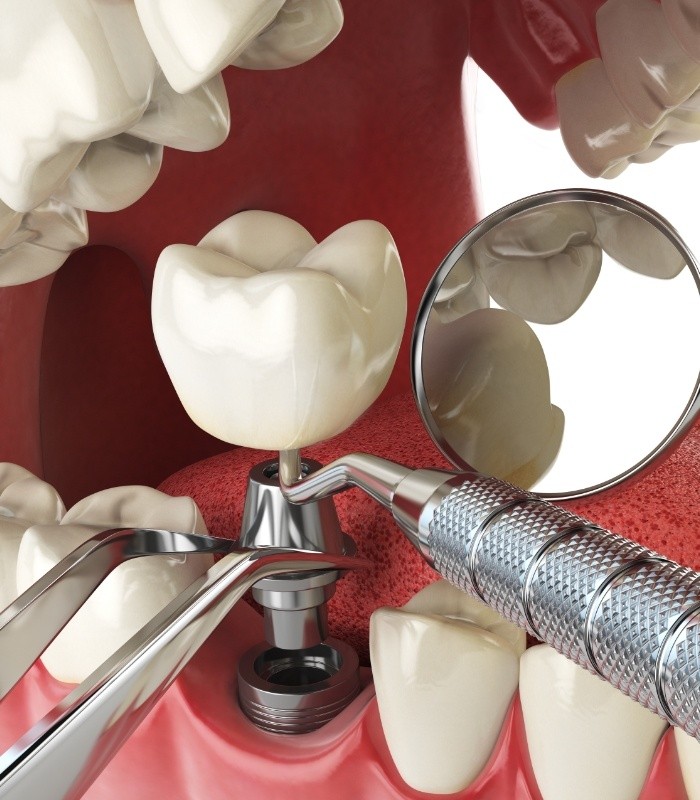 Illustrated dental implant being placed in the lower jaw