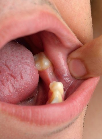 Close up of person pointing to their mouth with a missing tooth