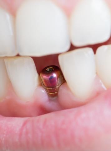 Close up of smile with visible abutment for one tooth
