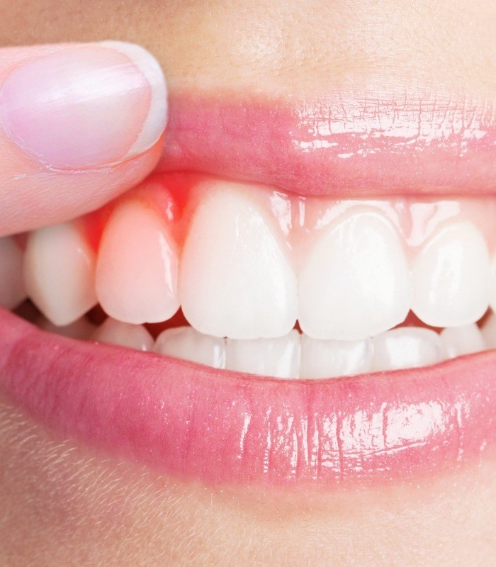 Close up of a person pointing to their red gums before gum disease treatment