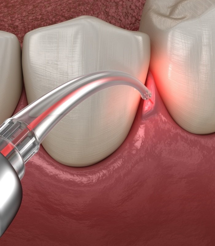 Illustrated dental laser treating gum disease