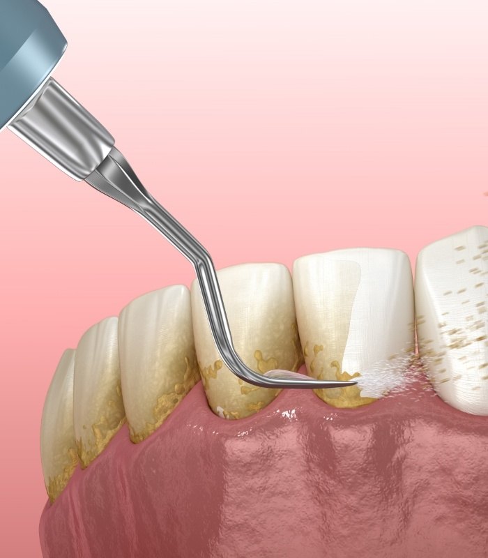 Illustrated dental instrument clearing plaque buildup from teeth