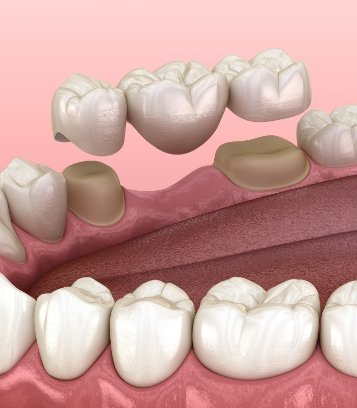 Illustrated dental bridge replacing a missing tooth