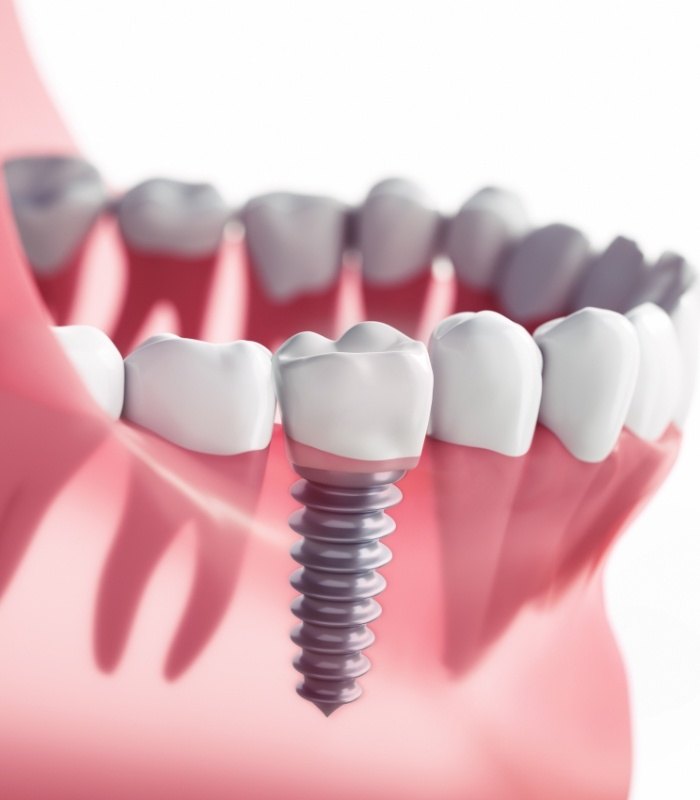 Illustrated dental implant replacing a missing tooth