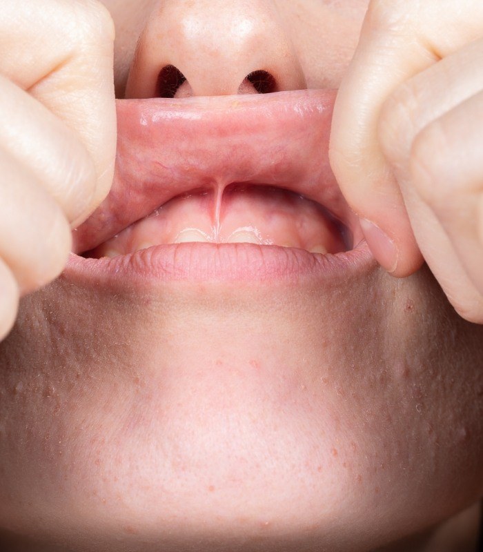 Close up of a person pulling back their upper lip