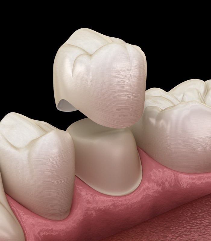 Illustrated dental crown being placed onto a tooth