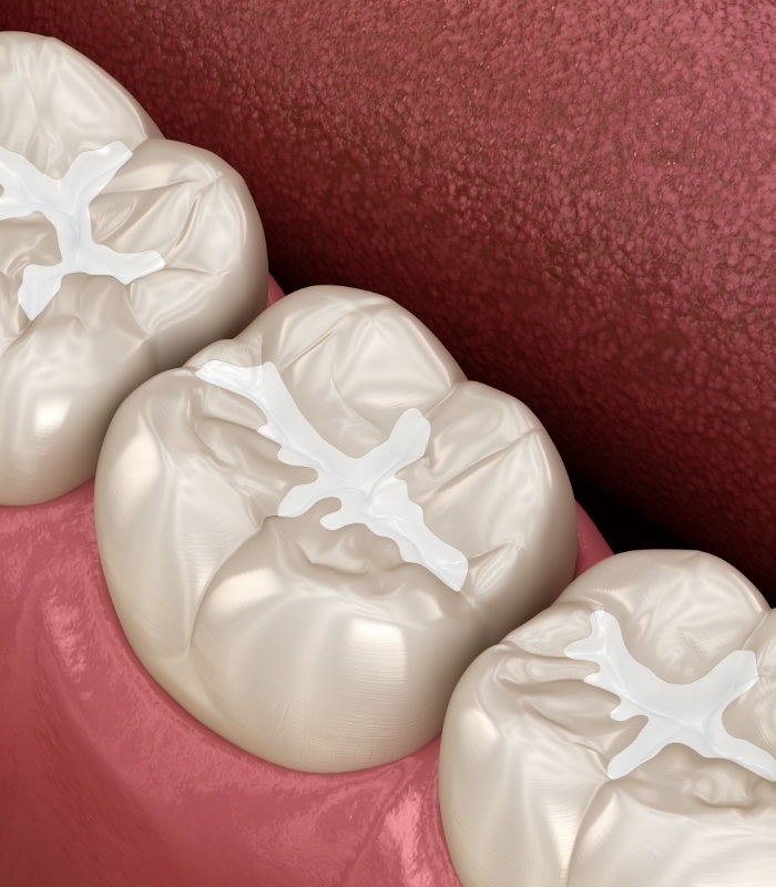 Illustrated teeth with white fillings