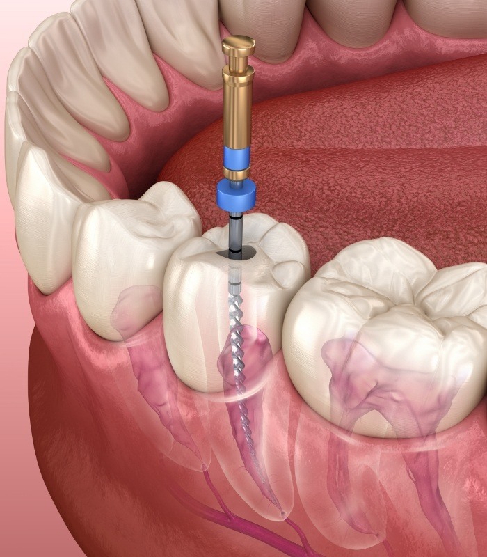 Illustrated dental tool cleaning inside tooth during root canal treatment