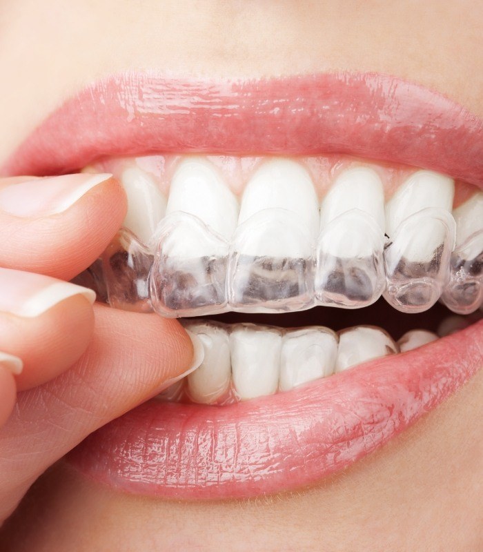 Close up of person putting clear aligner over their teeth